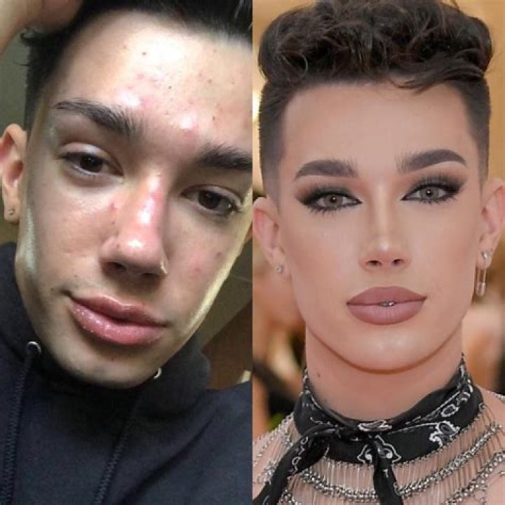 Did James Charles Get Plastic Surgery?