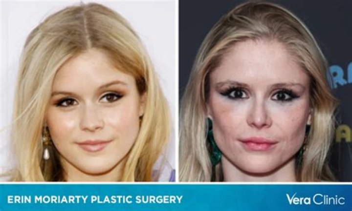 Erin Moriarty Buccal Fat Removal: Before And After Jaw Photos