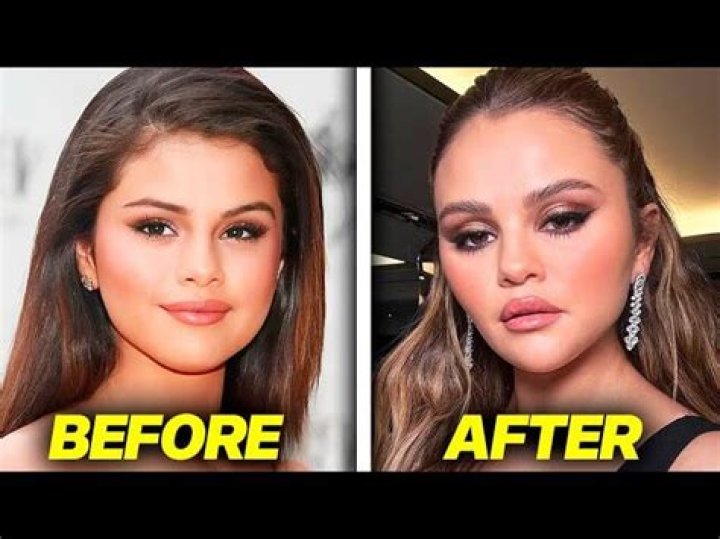 Has Selena Gomez Had Plastic Surgery? Thought to Have Breast Augmentation