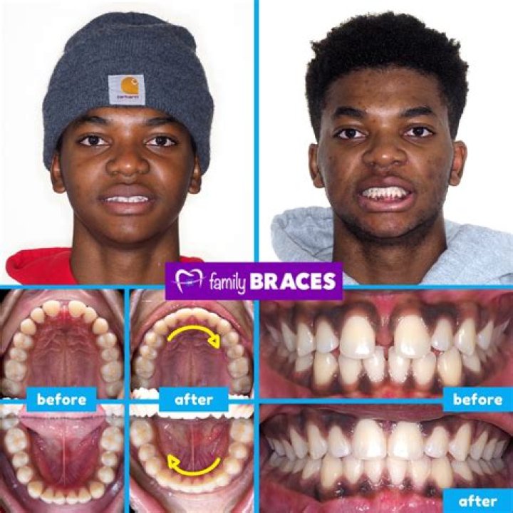 Joe Burrow Teeth Before And After: Has He Used Braces