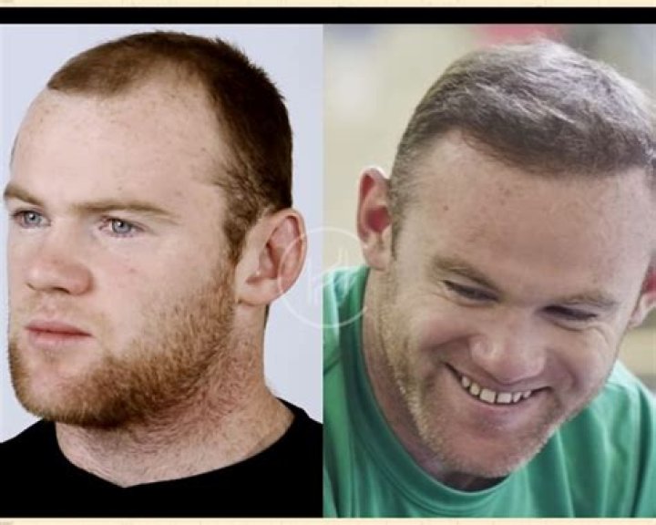 Leigh Griffiths Hair Transplant Before And After