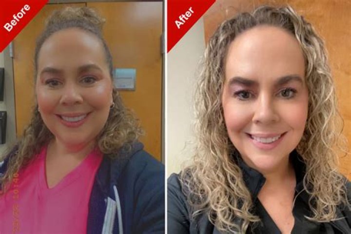 Travis Kelce Teeth Surgery Trending On Tiktok: Before And After Photo
