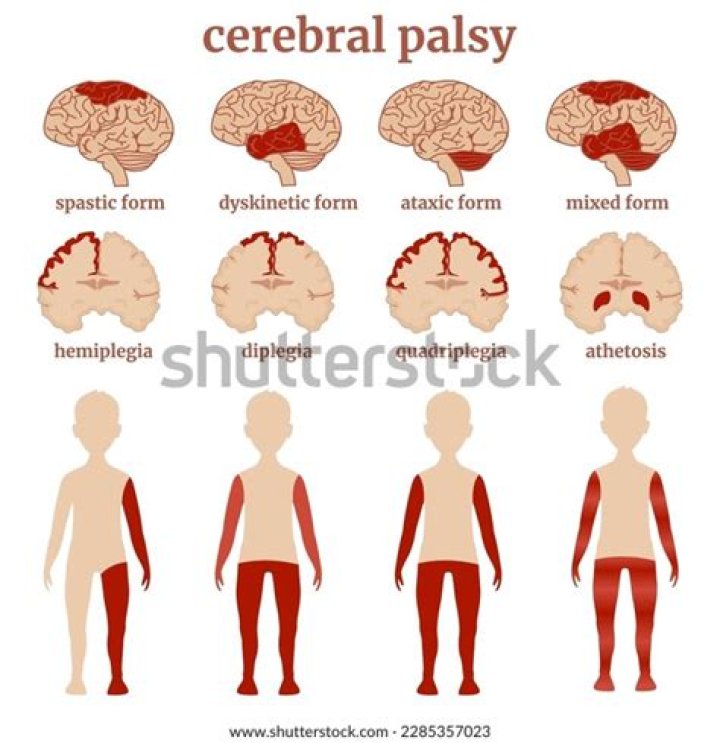 Was Luna Isabel Magalona Cerebral Palsy Linked To Death Cause? Siblings